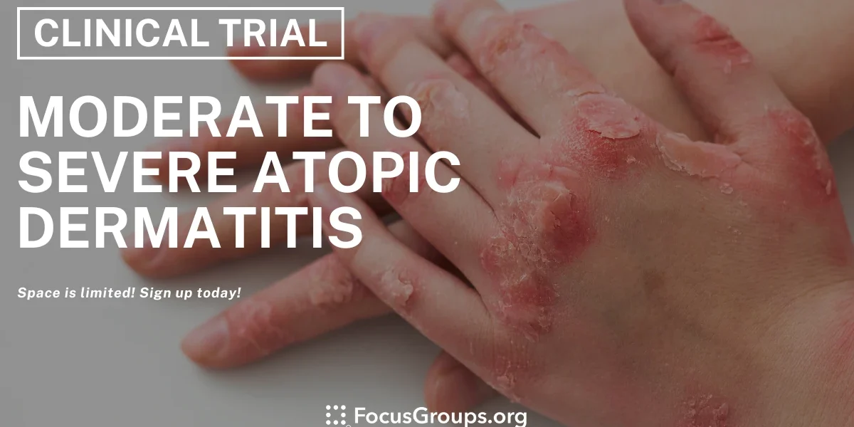 Clinical Trial on Moderate to Severe Atopic Dermatitis - Varies - 04/23 ...