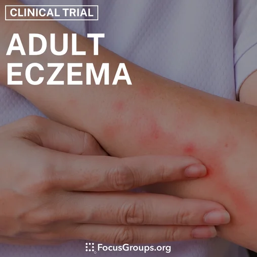 Clinical Trial on Adult Eczema