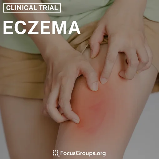 Clinical Trial on Eczema