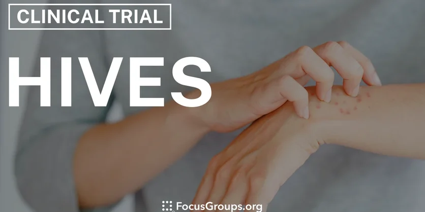 Clinical Trial on Hives - Varies - 12/10/2024
