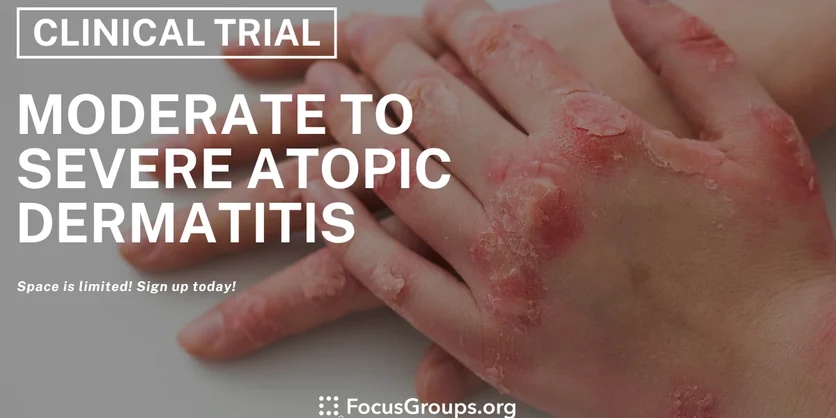 Clinical Trial on Moderate to Severe Atopic Dermatitis - Varies - 04/23/2024