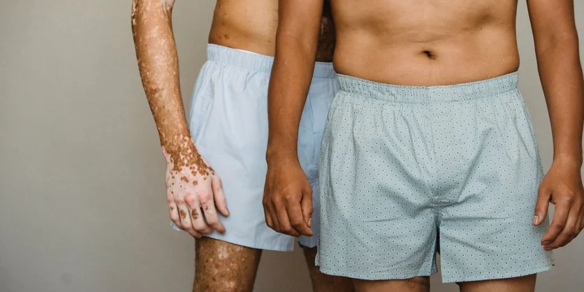 Online Interview on Vitiligo - $75 - $75 - 08/14/2026