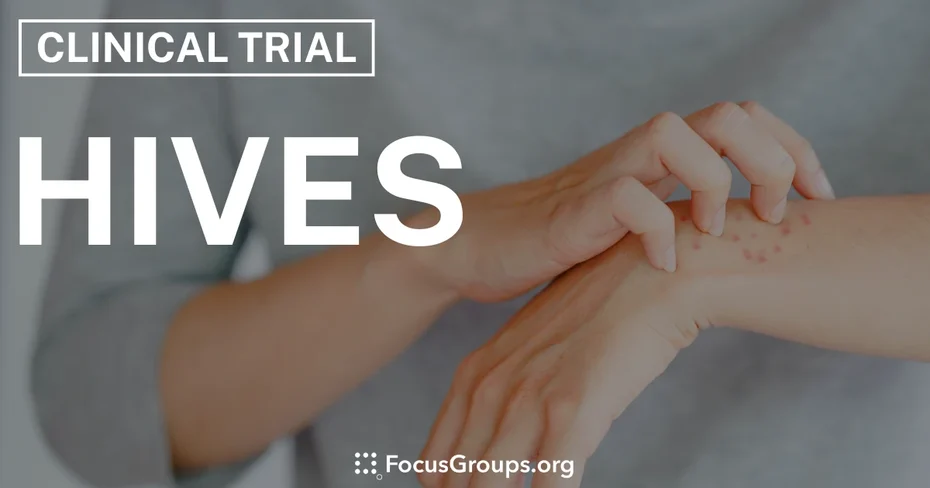 Clinical Trial on Hives