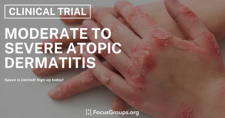 Clinical Trial on Moderate to Severe Atopic Dermatitis